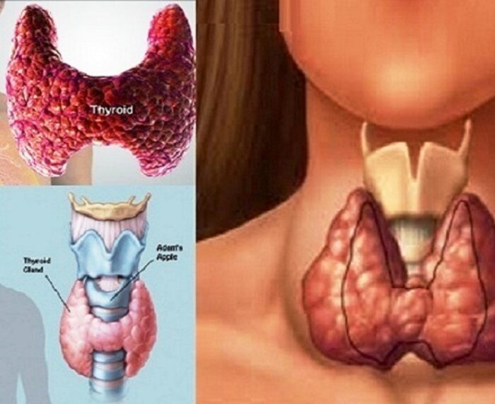 थाइराइड छ ?, यी ५ चीजबाट जोगिनुस्